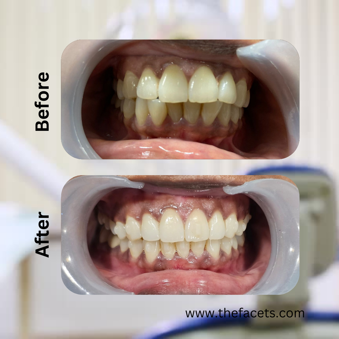Before and after braces treatment result 12